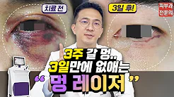 멍 없애는 가장 빠른 방법! 치료과정 공개 | 전후사진 모음 | 실제치료사례 (feat.브이빔 프리마)